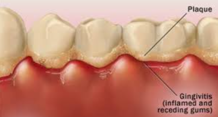 gula batu dapat menyebabkan gingivitis