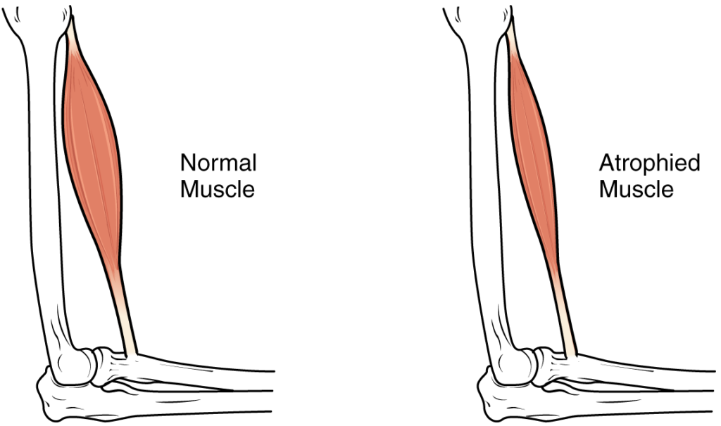 Atrofi otot dan bokong 
