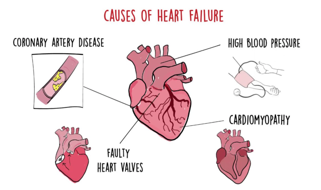 Penyebab gagal jantung