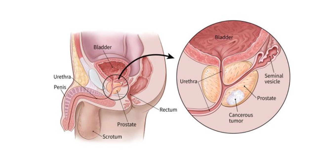 Waspada Kanker Prostat! Kenali Penyebabnya Sejak Dini - Blog ruparupa
